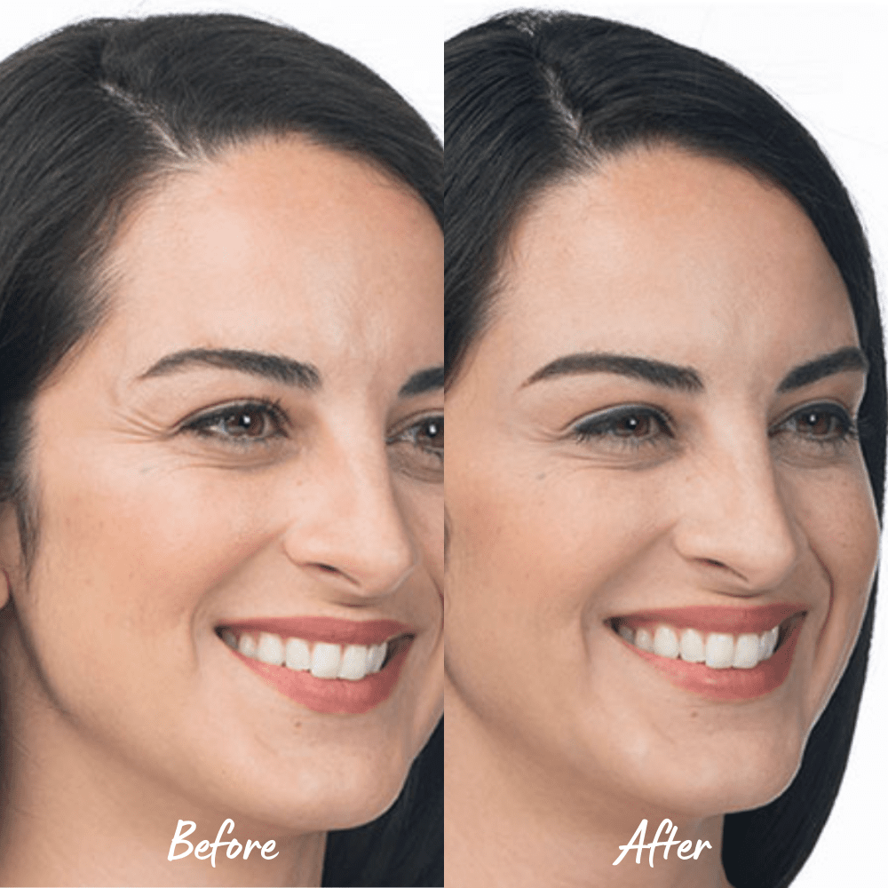 Beauty Treatment Before & After Photos | Newport Beach, CA, | The Beauty Hut Face & Body Sculpting