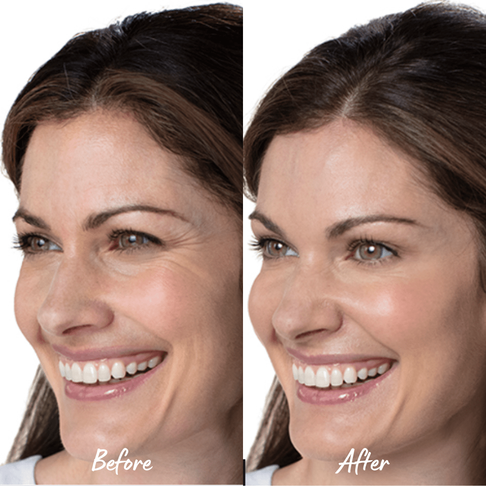 Botox Treatment Before & After Photos | Newport Beach, CA, | The Beauty Hut Face & Body Sculpting