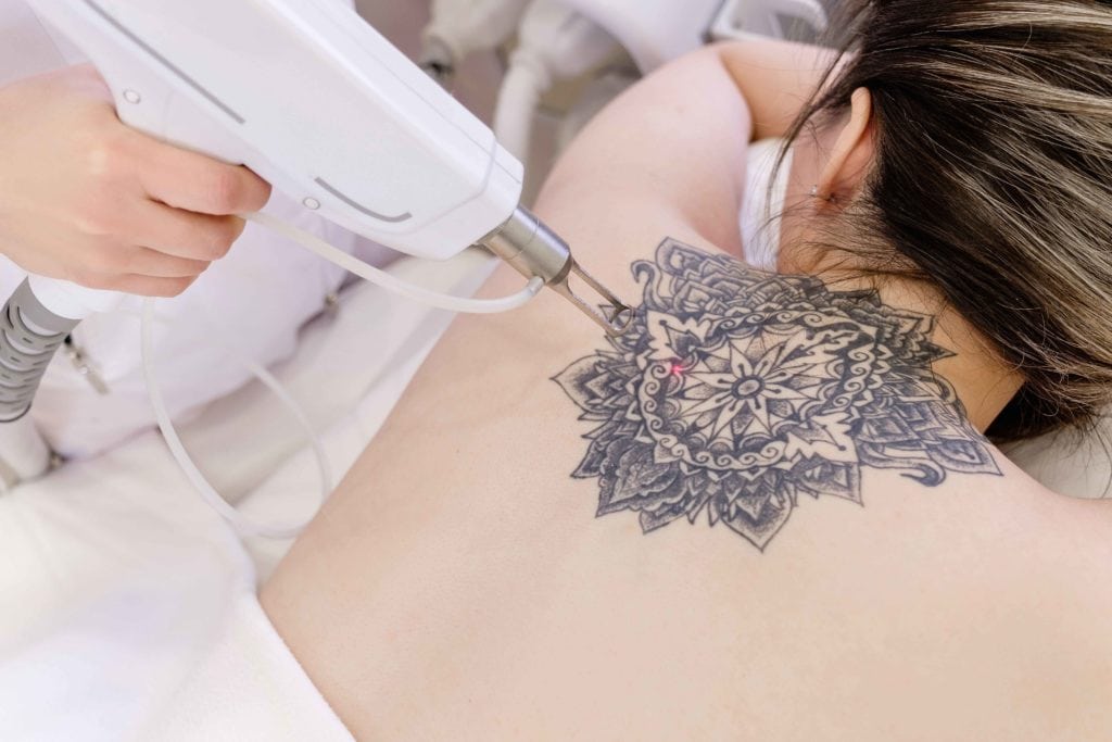 Tattoo-Removal-By-The-Beauty-Hut-in- Newport Beach-CA