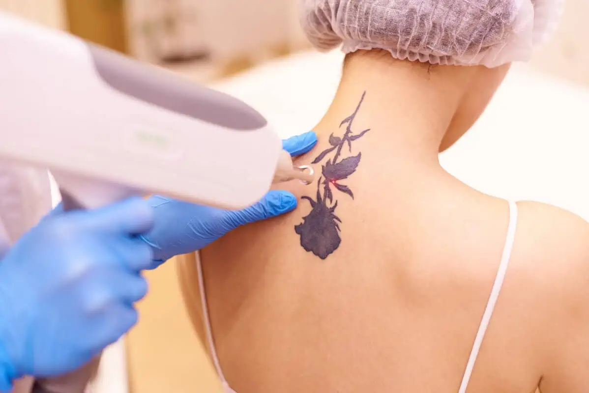 Tattoo Removal by The Beauty Hut Face & Body Sculpting in Newport Beach, CA