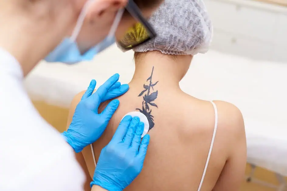 Tattoo Removal by The Beauty Hut LLC in Newport Beach, CA