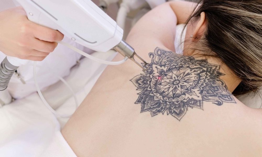Tattoo-Removal-By-The-Beauty-Hut-in- Newport Beach-CA