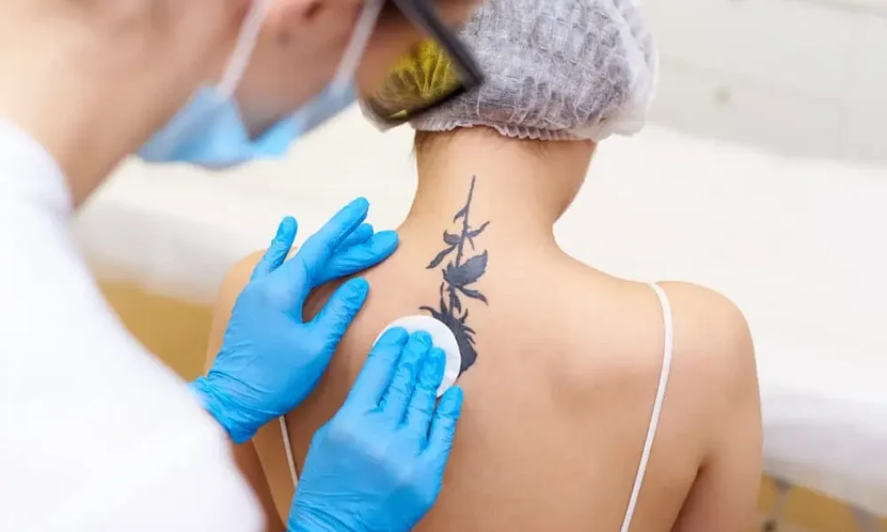 Tattoo Removal by The Beauty Hut LLC in Newport Beach, CA