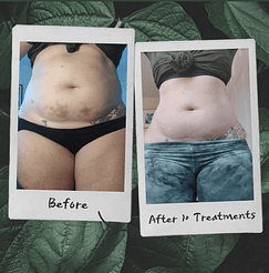 Weight loss Before & After Treatment Photos | Newport Beach, CA, | The Beauty Hut Face & Body Sculpting
