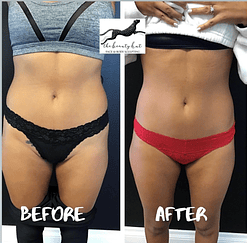 Weight loss Before & After Treatment Photos | Newport Beach, CA, | The Beauty Hut Face & Body Sculpting